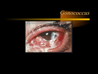 Gonococcus
 