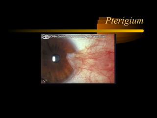 Pterigium
 