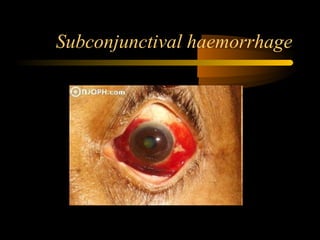 Subconjunctival haemorrhage
 