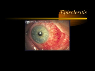 Episcleritis
 