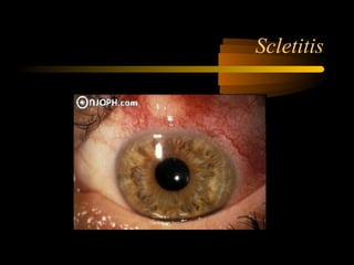 Scletitis
 