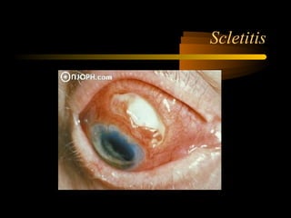 Scletitis
 