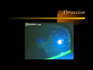 Abrassion
 