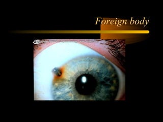 Foreign body
 