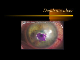 Dendritic ulcer
 