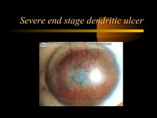 Severe end stage dendritic ulcer
 