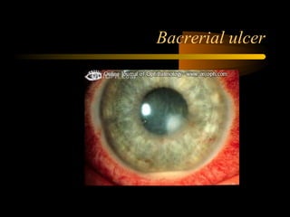 Bacrerial ulcer
 