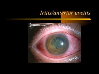 Iritis/anterior uveitis
 