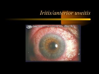 Iritis/anterior uveitis
 