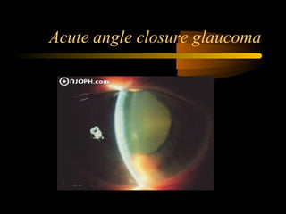 Acute angle closure glaucoma
 