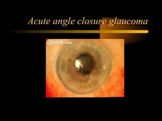 Acute angle closure glaucoma
 