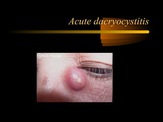 Acute dacryocystitis
 