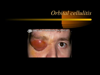 Orbital cellulitis
 