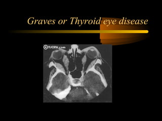 Graves or Thyroid eye disease
 