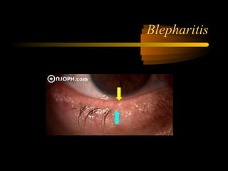 Blepharitis
 