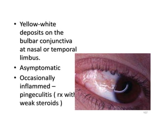 • Yellow-white
deposits on the
bulbar conjunctiva
at nasal or temporal
limbus.
• Asymptomatic
• Occasionally
inflammed –
pingeculitis ( rx with
weak steroids )
107
 
