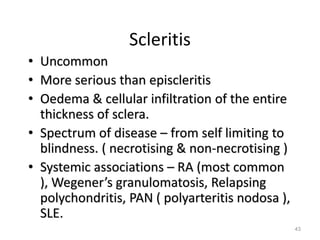 Scleritis
• Uncommon
• More serious than episcleritis
• Oedema & cellular infiltration of the entire
thickness of sclera.
• Spectrum of disease – from self limiting to
blindness. ( necrotising & non-necrotising )
• Systemic associations – RA (most common
), Wegener’s granulomatosis, Relapsing
polychondritis, PAN ( polyarteritis nodosa ),
SLE.
43
 