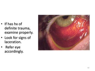 • If has hx of
definite trauma,
examine properly.
• Look for signs of
laceration.
• Refer eye
accordingly.
92
 