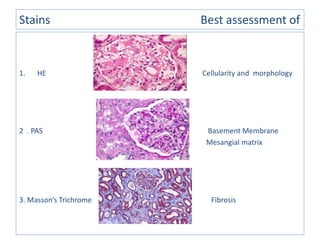 Stains Best assessment of
1. HE Cellularity and morphology
2 . PAS Basement Membrane
Mesangial matrix
3. Masson’s Trichrome Fibrosis
 