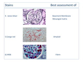 Stains Best assessment of
4. Jones Silver Basement Membrane
Mesangial matrix
5.Congo red Amyloid
6) MSB Fibrin
 