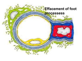 Effacement of foot
processess
 