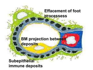 Effacement of foot
processess
Subepithelial
immune deposits
BM projection between
deposits
 