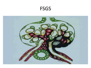 FSGS
 