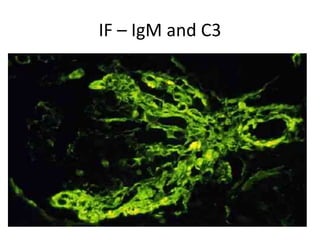 IF – IgM and C3
 