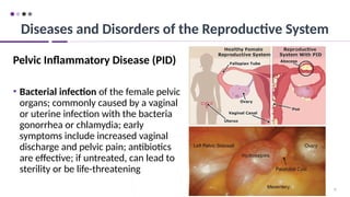 91
Pelvic Inflammatory Disease (PID)
• Bacterial infection of the female pelvic
organs; commonly caused by a vaginal
or uterine infection with the bacteria
gonorrhea or chlamydia; early
symptoms include increased vaginal
discharge and pelvic pain; antibiotics
are effective; if untreated, can lead to
sterility or be life-threatening
Diseases and Disorders of the Reproductive System
 