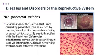 92
Non-gonococcal Urethritis
• Inflammation of the urethra that is not
caused by gonorrhea; can be caused by
trauma, insertion of a nonsterile catheter,
or sexual contact; usually due to infection
with the bacterium Chlamydia
trachomatis; may go unnoticed and result
in pelvic inflammatory disease or sterility;
antibiotics are effective treatment
Diseases and Disorders of the Reproductive System
 