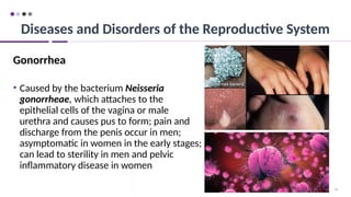 94
Gonorrhea
• Caused by the bacterium Neisseria
gonorrheae, which attaches to the
epithelial cells of the vagina or male
urethra and causes pus to form; pain and
discharge from the penis occur in men;
asymptomatic in women in the early stages;
can lead to sterility in men and pelvic
inflammatory disease in women
Diseases and Disorders of the Reproductive System
 