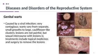 96
Genital warts
• Caused by a viral infection; very
contagious; warts vary from separate,
small growths to large, cauliflower-like
clusters; lesions are not painful, but
sexual intercourse with lesions is;
treatments include topical medicines
and surgery to remove the lesions
Diseases and Disorders of the Reproductive System
 