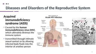 98
Acquired
immunodeficiency
syndrome (AIDS)
• Caused by the human
immunodeficiency virus (HIV),
which ultimately destroys the
immune system
• transmitted through intimate
sexual contact or by allowing
infected body fluids into the
interior of another person
Diseases and Disorders of the Reproductive System
 