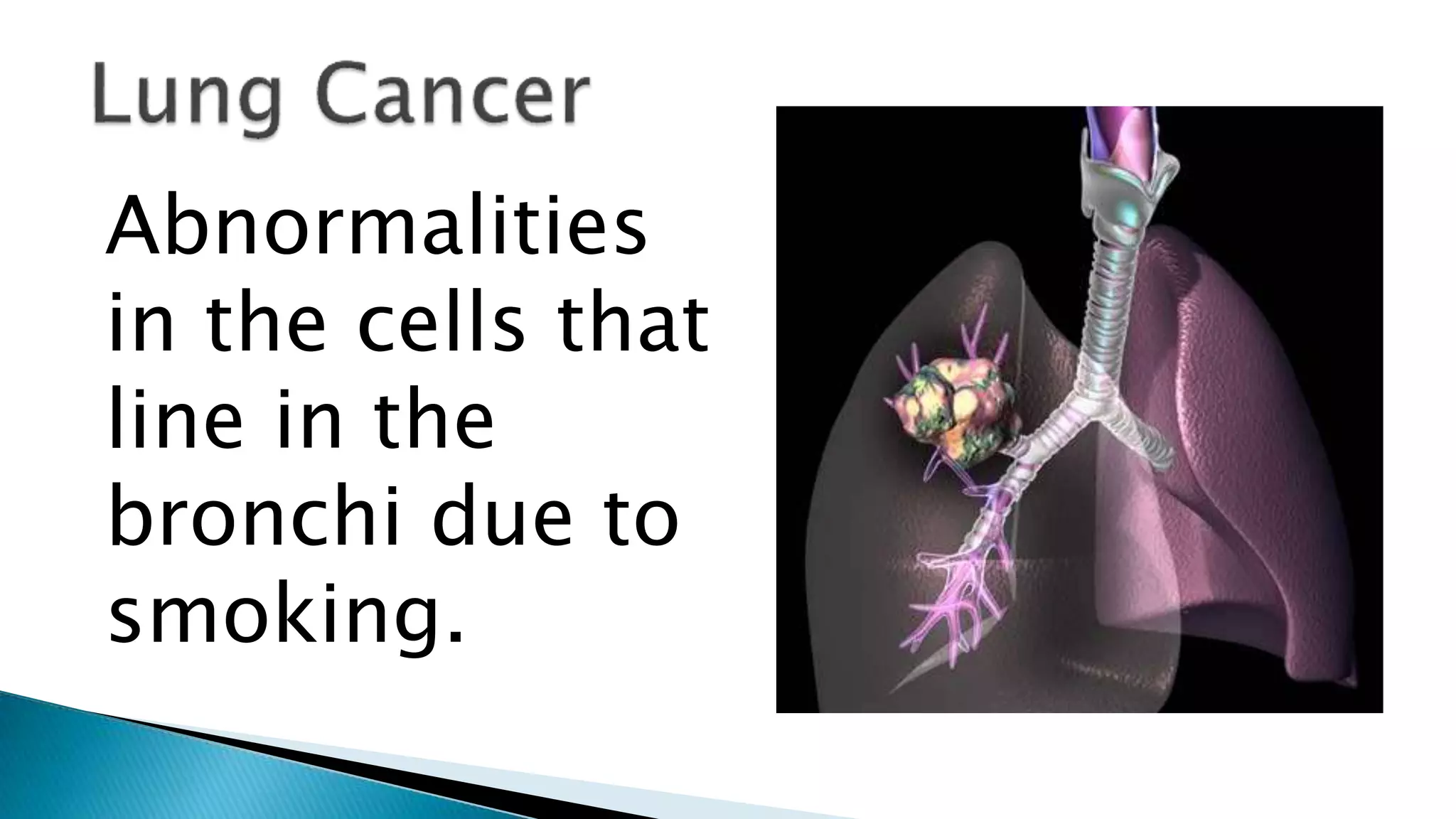 Abnormalities
in the cells that
line in the
bronchi due to
smoking.