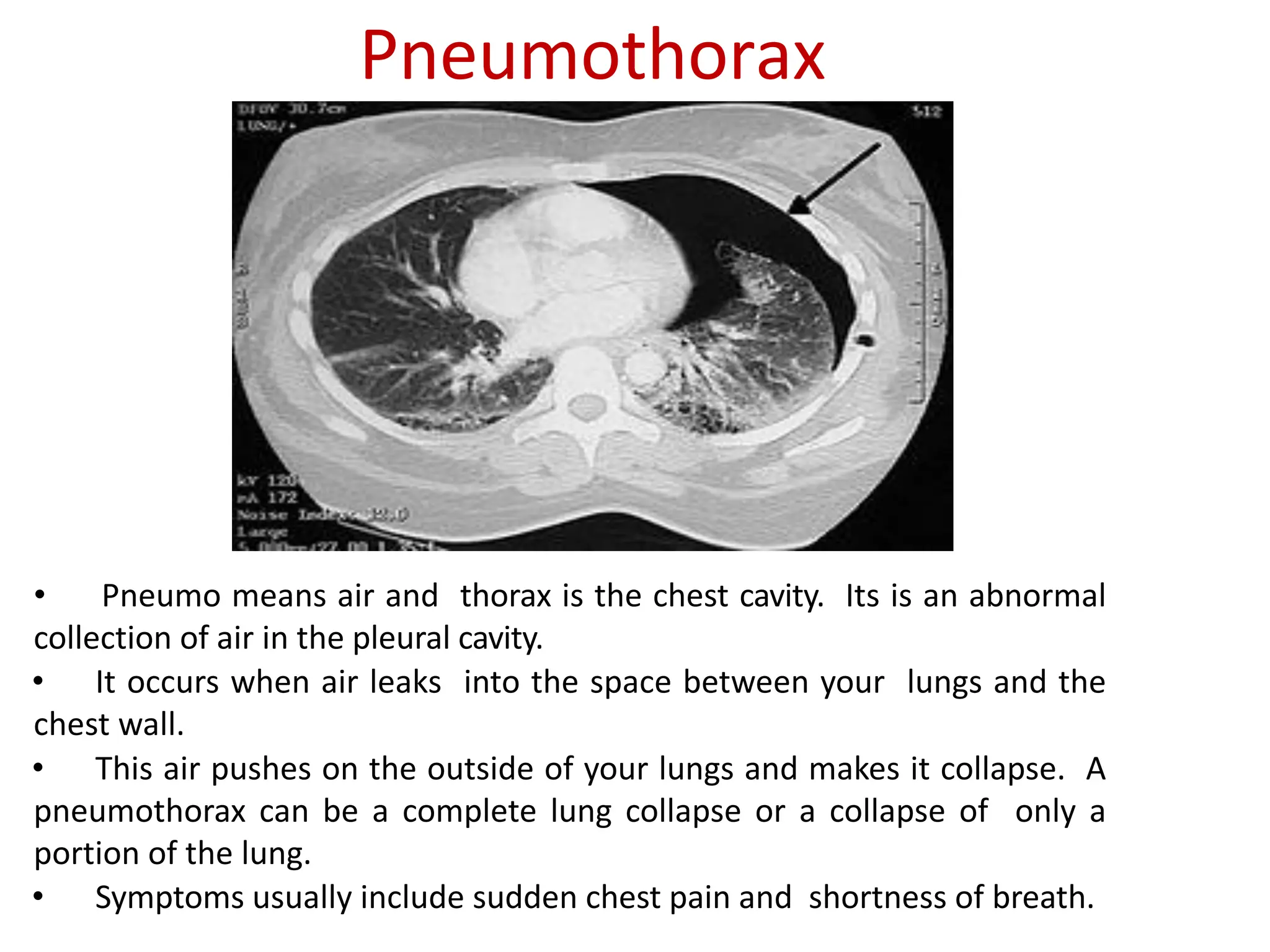 Pneumothorax
• Pneumo means air and thorax is the chest cavity. Its is an abnormal
collection of air in the pleural cavity.
• It occurs when air leaks into the space between your lungs and the
chest wall.
• This air pushes on the outside of your lungs and makes it collapse. A
pneumothorax can be a complete lung collapse or a collapse of only a
portion of the lung.
• Symptoms usually include sudden chest pain and shortness of breath.
 