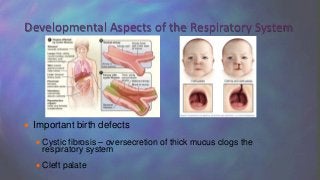  Important birth defects
 Cystic fibrosis – oversecretion of thick mucus clogs the
respiratory system
 Cleft palate
Developmental Aspects of the Respiratory System
 