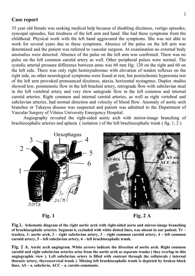 The Right Aortic Arch with Mirror Image Branching of Brachiocephalic Arteries and Aplasia of the