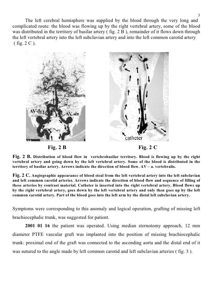 The Right Aortic Arch with Mirror Image Branching of Brachiocephalic