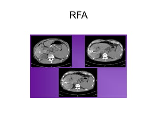 Distorted Rfa Scan Ut Thermal ablation techniques in interventional radiology | PPTX