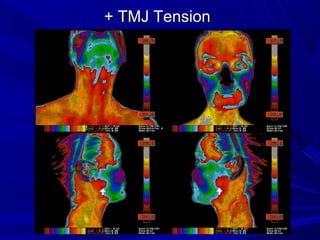 + TMJ Tension
 