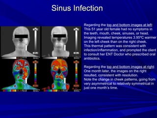 Sinus Infection
         Regarding the top and bottom images at left:
         This 51 year old female had no symptoms in
         the teeth, mouth, cheek, sinuses, or head.
         Imaging revealed temperatures 3.95ºC warmer
         on the left cheek than on the right cheek.
         This thermal pattern was consistent with
         infection/inflammation, and prompted the client
         to consult her ENT Doctor who prescribed oral
         antibiotics.

         Regarding the top and bottom images at right:
         One month later, the images on the right
         resulted, consistent with resolution.
         Note the change in cheek patterns, going from
         very asymmetrical to relatively symmetrical in
         just one month’s time.
 