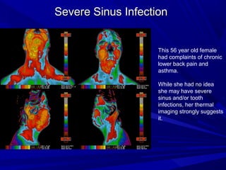 Severe Sinus Infection


                    This 56 year old female
                    had complaints of chronic
                    lower back pain and
                    asthma.

                    While she had no idea
                    she may have severe
                    sinus and/or tooth
                    infections, her thermal
                    imaging strongly suggests
                    it.
 