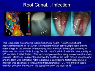 Root Canal... Infection




This female had no concerns regarding her oral health. Note the significant
heat/thermal finding at "B", which is consistent with an active lymph node, among
other things. In the event of an underlying tooth infection, she sought dentistry to
determine the cause of this finding. Dental xray of tooth #18 indicated abnormality at
"C", consistent with infection. This tooth had previously undergone root canal and was
crowned. Months of treatment to improve the health of the tooth proved unsuccessful,
and the tooth was extracted. After extraction, a contributing factor/likely cause of
infection was observed: a long/vertical fracture/crack at "D". Note the soft tissue
infection between the roots on the opposite side of the tooth at "E".
 