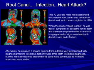 Root Canal.... Infection...Heart Attack?
                                         This 72 year old male had experienced
                                         innumerable root canals and decades of
                                         dental work which was completed in 1998.

                                         When thermally imaged in 2009, he was
                                         free of symptoms or concerns for his teeth
                                         and therefore surprised when his thermal
                                         imaging revealed signs consistent with
                                         dental issues and infection.




Afterwards, he obtained a second opinion from a dentist very experienced with
diagnosing/treating infections. Not only were three tooth infections diagnosed,
but this male also learned that tooth #18 could have contributed to his heart
attack two years earlier.
 