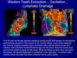 Wisdom Teeth Extraction... Cavitation...
             Lymphatic Drainage




This 54 year old female reported depleting energy levels and concern for developing
auto-immune disorders if the source of her chronic fatigue could not be resolved.
Her thermal imaging revealed signs consistent with potential dental issues and
infection with lymphatic involvement/drainage into the chest. Note the excess heat
and thermal patterns along the left chest. While her follow-up tests were normal for
the breast, her dentist diagnosed 2 cavitations in her right jaws - in wisdom teeth
sockets where the teeth had been extracted twenty years earlier.
 