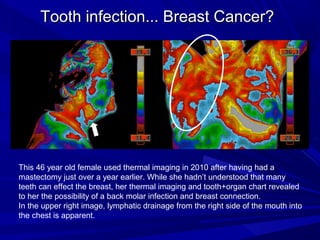 Tooth infection... Breast Cancer?




This 46 year old female used thermal imaging in 2010 after having had a
mastectomy just over a year earlier. While she hadn’t understood that many
teeth can effect the breast, her thermal imaging and tooth+organ chart revealed
to her the possibility of a back molar infection and breast connection.
In the upper right image, lymphatic drainage from the right side of the mouth into
the chest is apparent.
 
