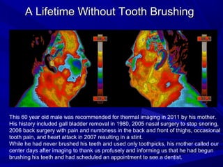 A Lifetime Without Tooth Brushing




This 60 year old male was recommended for thermal imaging in 2011 by his mother.
His history included gall bladder removal in 1980, 2005 nasal surgery to stop snoring,
2006 back surgery with pain and numbness in the back and front of thighs, occasional
tooth pain, and heart attack in 2007 resulting in a stint.
While he had never brushed his teeth and used only toothpicks, his mother called our
center days after imaging to thank us profusely and informing us that he had begun
brushing his teeth and had scheduled an appointment to see a dentist.
 