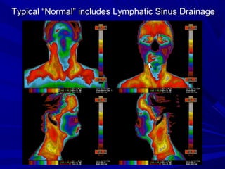 Typical “Normal” includes Lymphatic Sinus Drainage
 