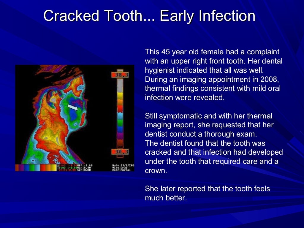 Thermal Imaging Examples of Tooth Issues