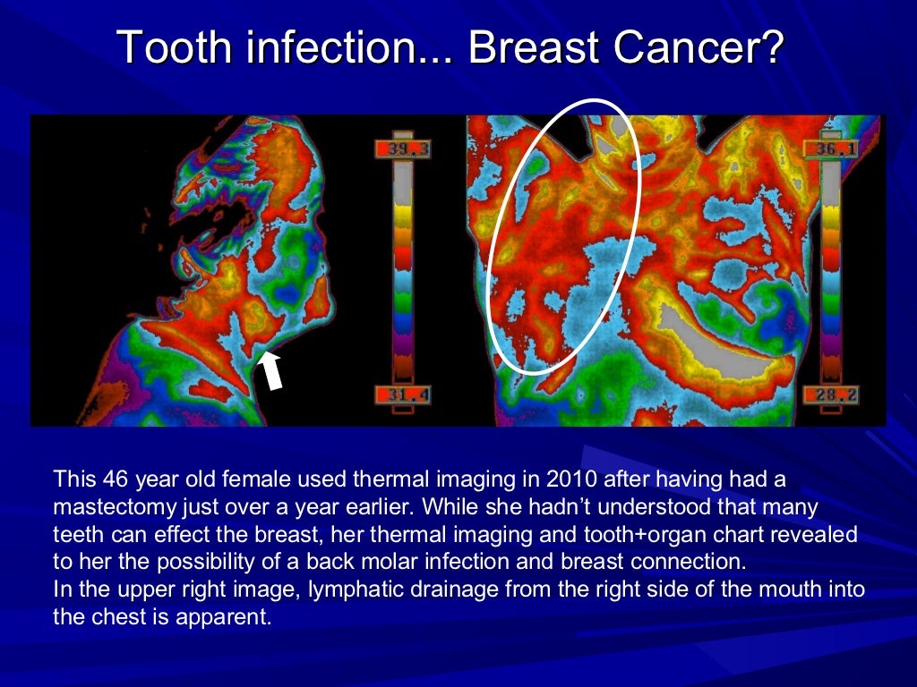 Thermal Imaging Examples of Tooth Issues
